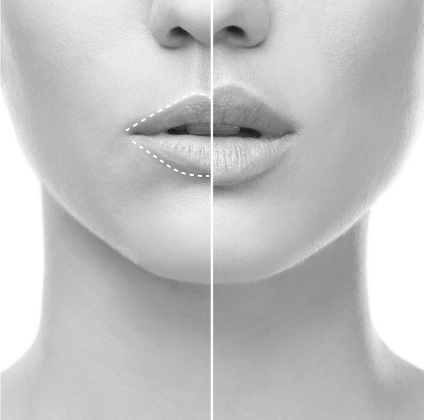 Esthetique Bellecour : Traitement volume des lèvres avec Pluryal Classic Lidocaîne - photos @pluryal